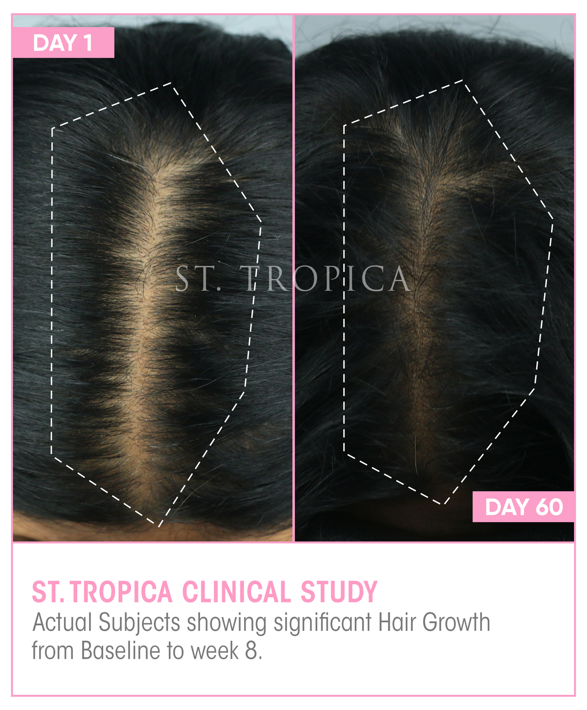 ST. TROPICA Hair Growth Vitamins - 60 Day Hair Challenge (2 Month Supply)