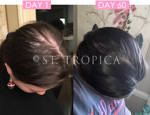 Telogen Effluvium Hair Loss ST. TROPICA