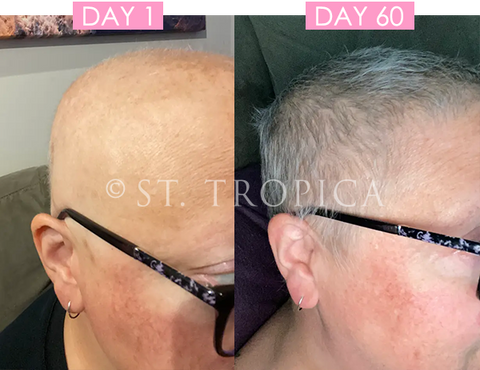 Share 110+ hair before and after chemo latest